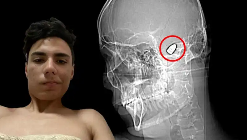 Kafasında Patlayıcı Taşıyan İnsan: Gerçek Hikaye ve Derin Duygular